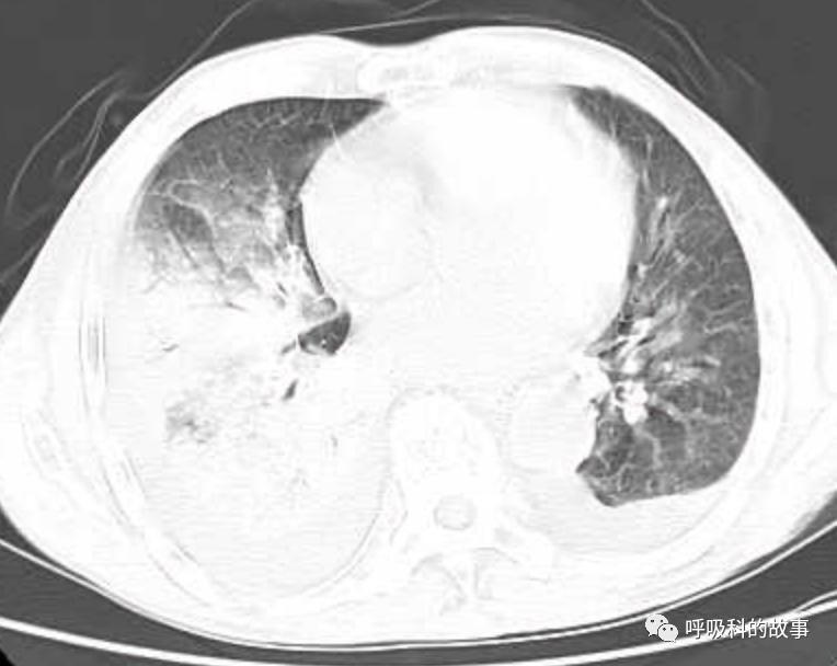肺炎的最佳治疗方法及药物,肺炎的治疗方法和流程