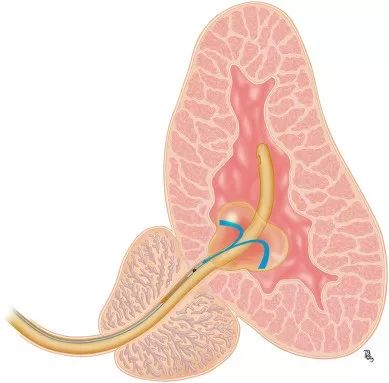 导尿管能打进去水但抽不出来,拔导尿管气囊怎么抽不出液体