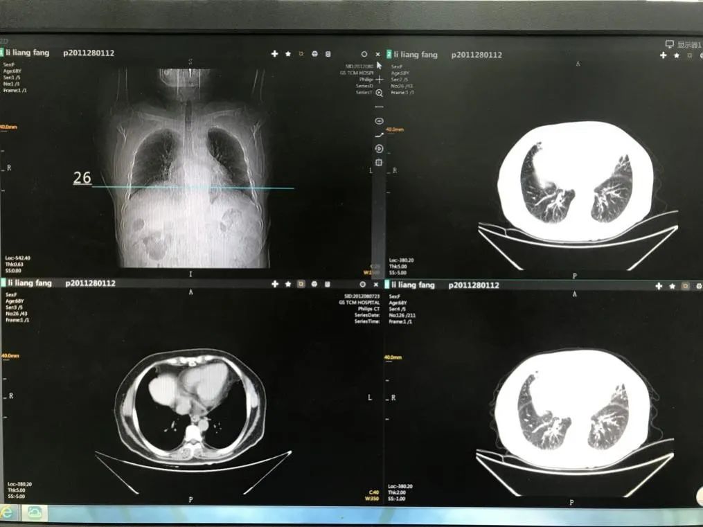 心力衰竭的胸腔积液有办法治疗吗,心力衰竭造成胸腔积液能治好吗