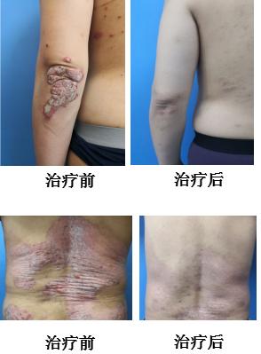 银屑病可以除根吗,唯一可以不复发的银屑病