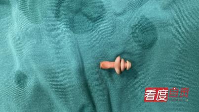 5岁小孩有异物,小儿吞异物一周未排出