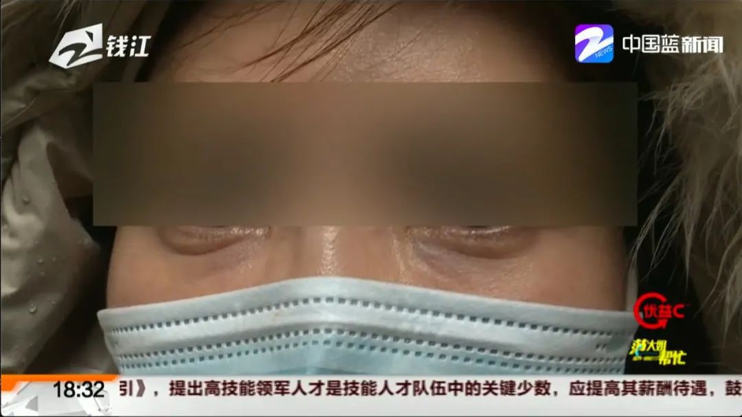 注射祛鱼尾纹,打鱼尾纹祛皱针后下眼睑皱纹变多