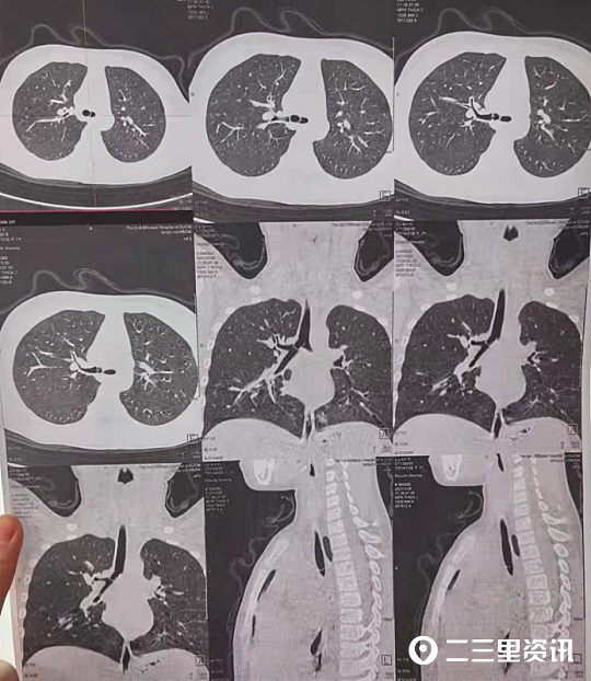 小孩误吞笔帽怎么办,小孩误吞笔帽吃什么能拉下来