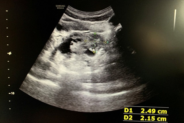 小女孩出现呕吐不止,小女孩呕吐不止