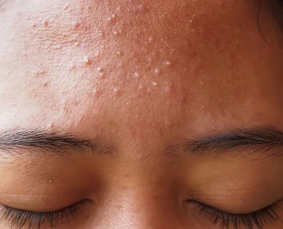 痘印形成了斑点越来越深怎么消除,磨掉色素沉着