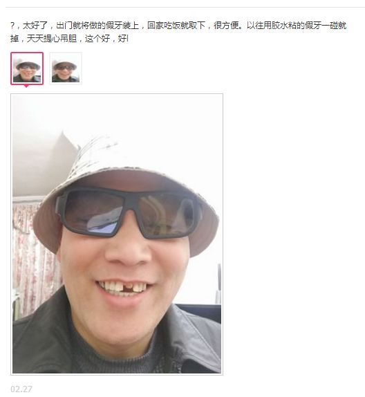 做一颗临时牙教程,自制隐形牙