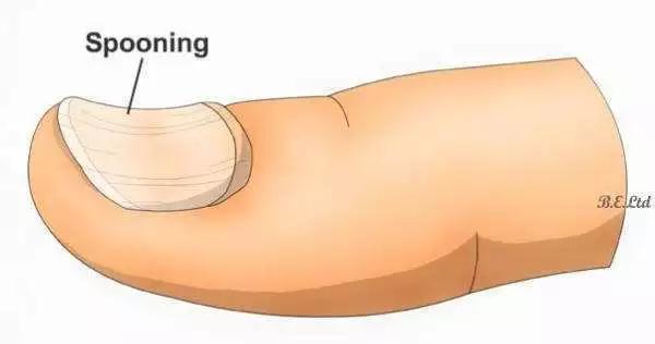 宝宝缺铁的表现及解决方法,孩子缺铁后果很严重一定要早发现