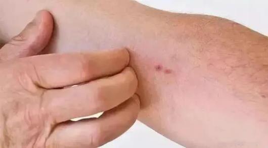 重庆北碚九院疤痕增生修复方法,上海九院孙沣