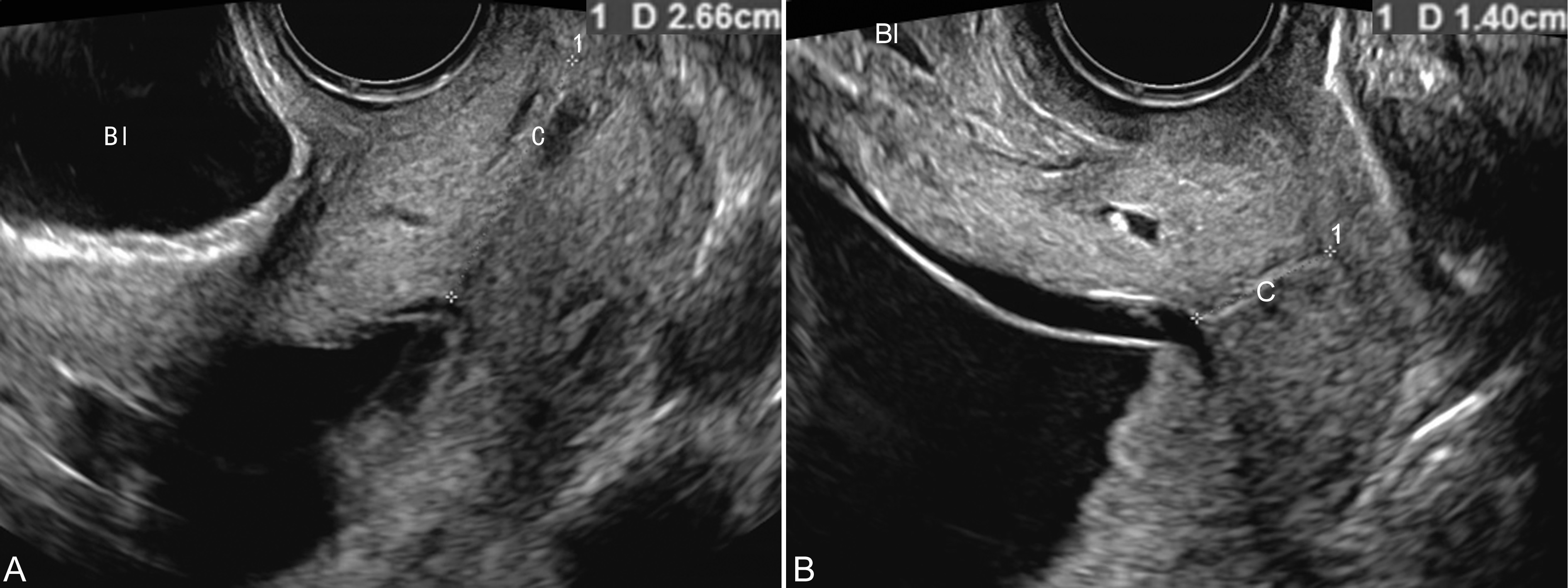 30周早产儿的脑部超声,早产儿超声检查