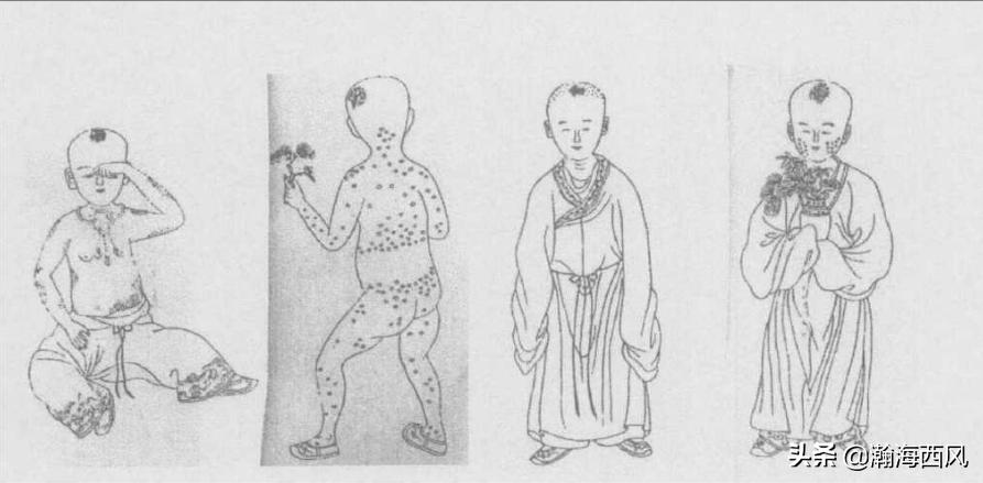 最早发明疫苗的科学家,世界上最早的牛痘接种方法