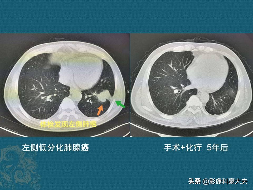 肺癌怎样才算局部晚期症状,肺癌分几种类型怎么吃药