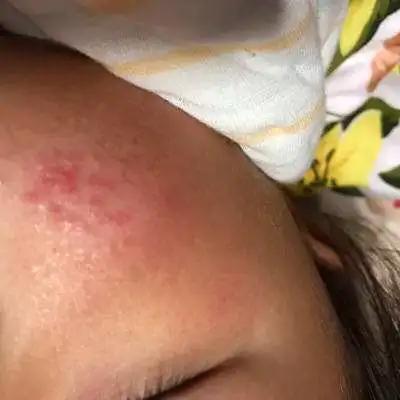 宝宝湿疹反反复复预防护理有技巧,宝宝湿疹的正确防治方法