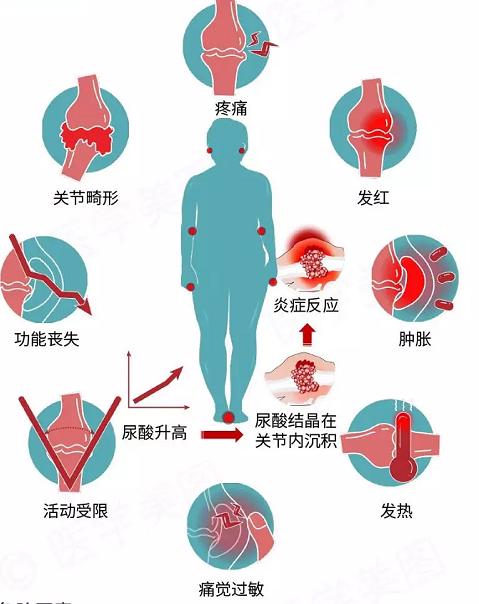 怎样知道痛风尿酸偏高,怎样知道有痛风结晶