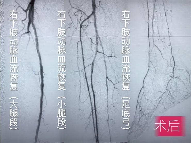 福州有下肢动脉硬化闭塞中医,辽宁中医治疗下肢动脉硬化闭塞