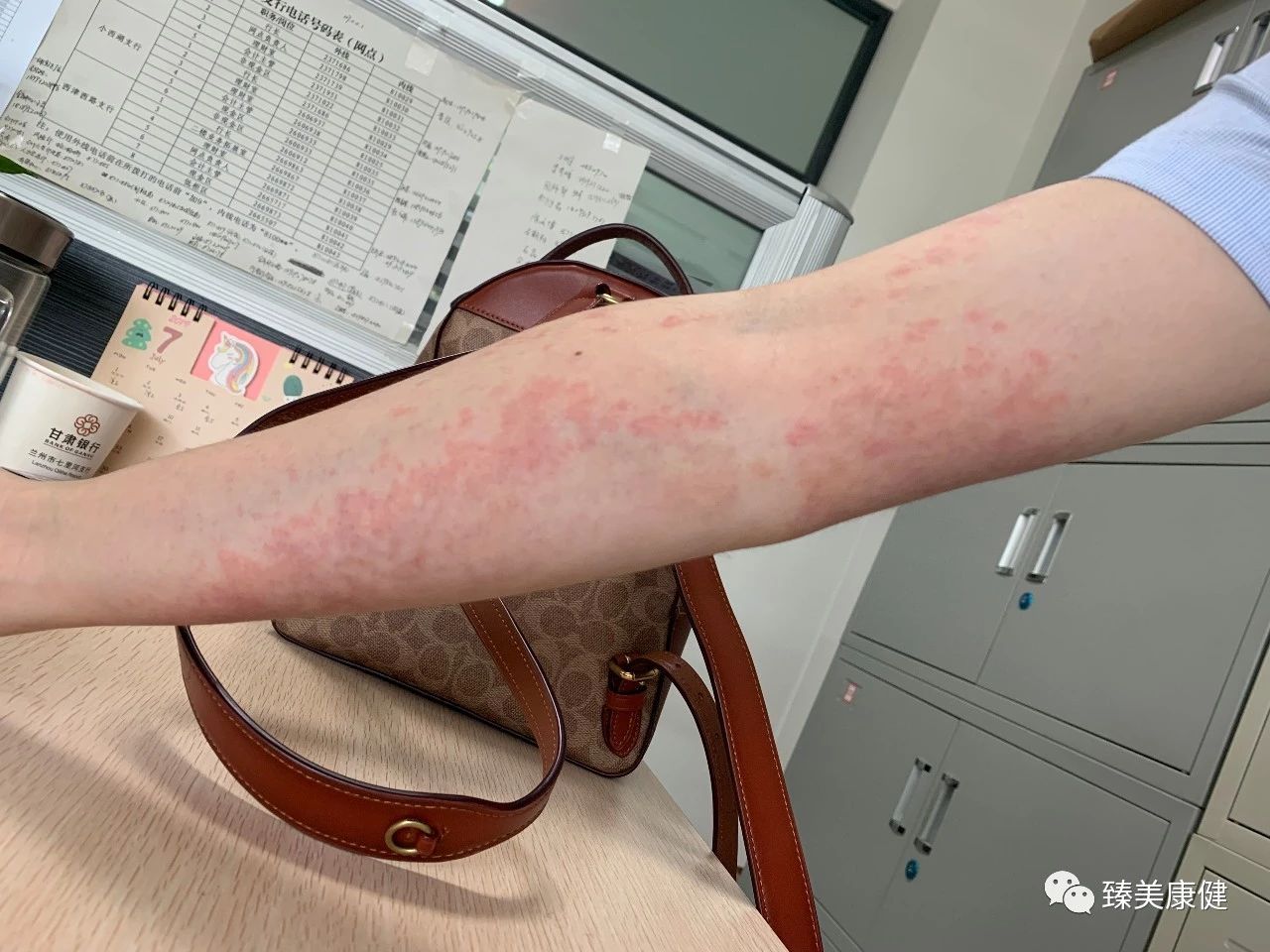 胃苓丸加什么药治湿疹,除湿胃苓丸治疗湿疹