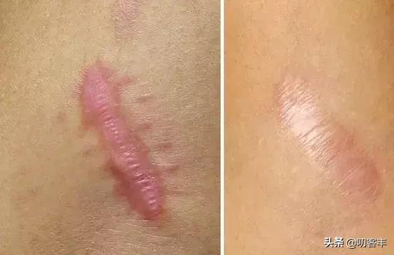 瘢痕疙瘩是怎么回事,瘢痕疙瘩治疗多少钱