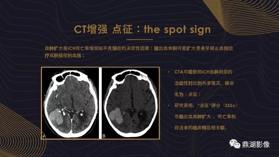 不简单|脑出血超详细学习笔记