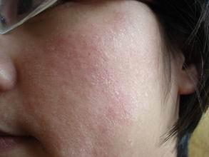 玉泽能修复角质层吗,角质层修复最快方法