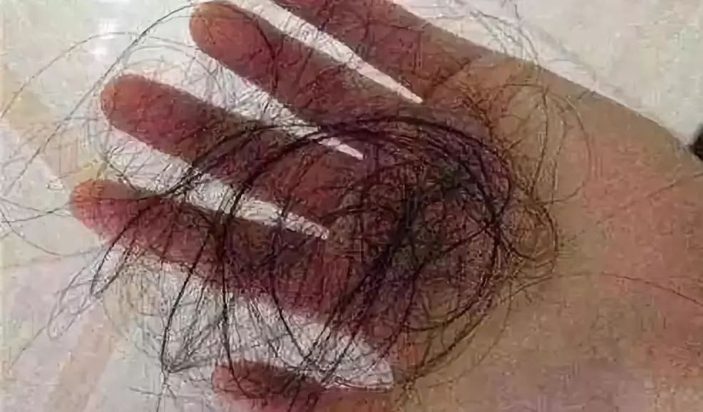 产后脱头发怎么补救,产后脱发的原因和方法