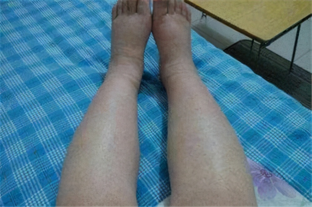 脚丫子都肿是什么原因造成的,脚丫子痛不肿关节痛怎么回事