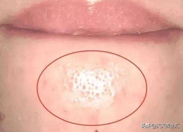 下巴有白色颗粒怎么解决,下巴有白色颗粒凸起是什么原因