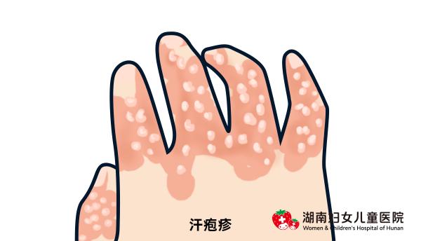 儿童身上皮疹反反复复怎么办,全身皮疹怎样止痒
