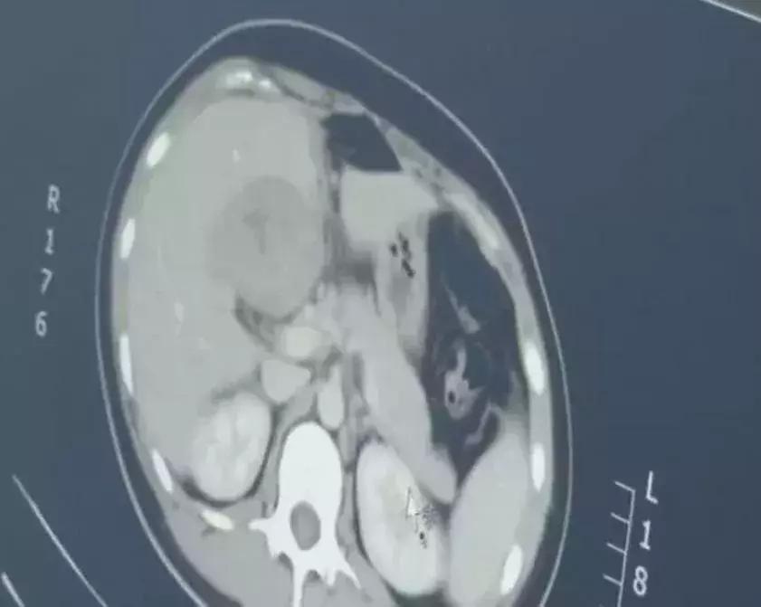 女子怀孕5个月胎儿却不见,怀孕三个月子宫小