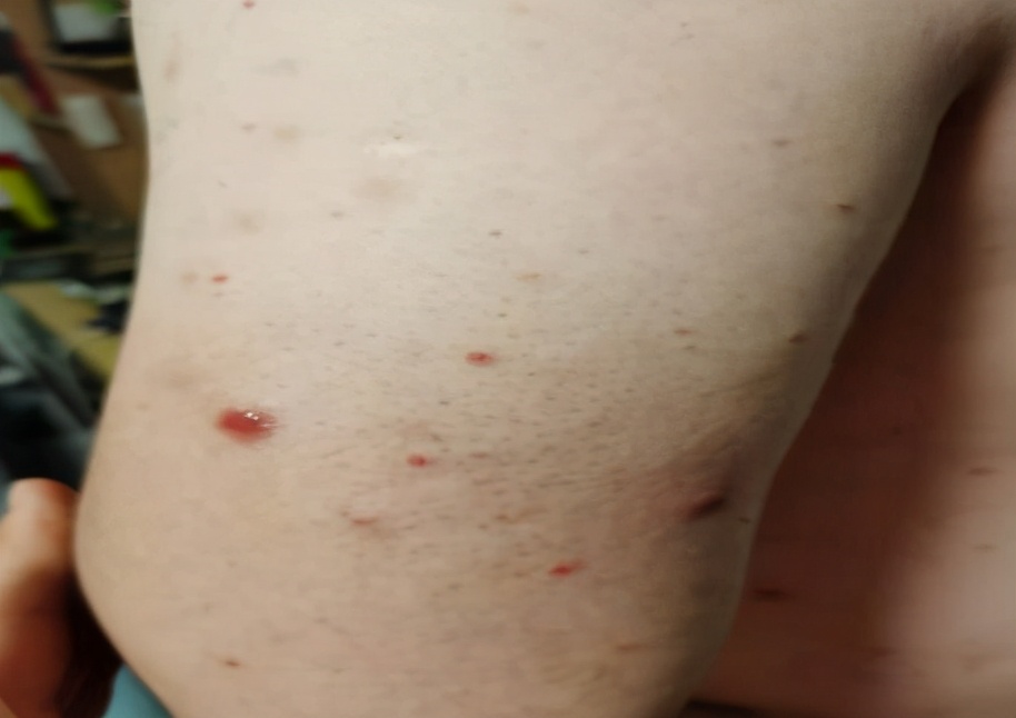 病例分享｜银屑病8年患者，采用中药调理，半个月就见好转