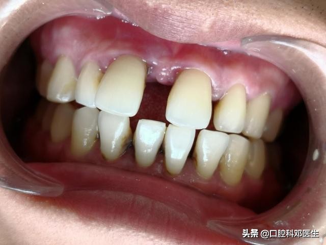 牙周炎导致门牙缝隙大,牙周炎引起门牙缝隙变大