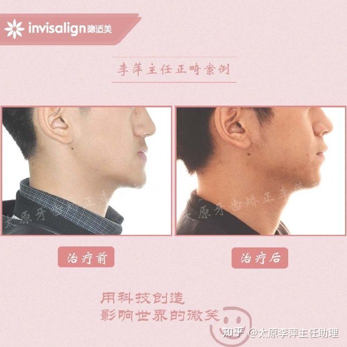 太原牙齿矫正靠谱吗,太原成人隐形牙套牙齿不齐