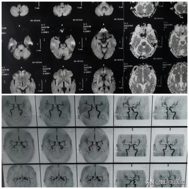 老人血管狭窄能活多久,头血管狭窄严重是否可以保守治疗