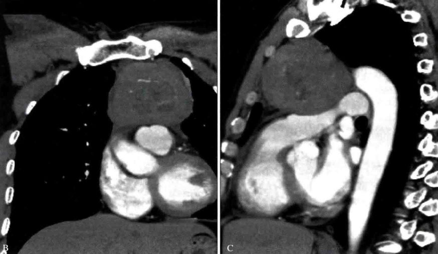前上纵隔高密度影考虑胸腺未退化,肺纵隔胸腺结节12mm看什么科