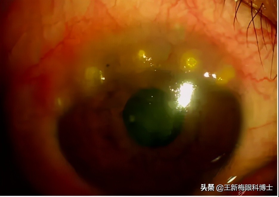 春季儿童过敏性结膜炎,儿童过敏性结膜炎眼睛痒怎么办