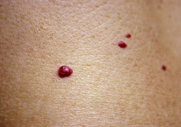 肝硬化蜘蛛痣什么情况会出现,出现蜘蛛痣了肝硬化到什么程度