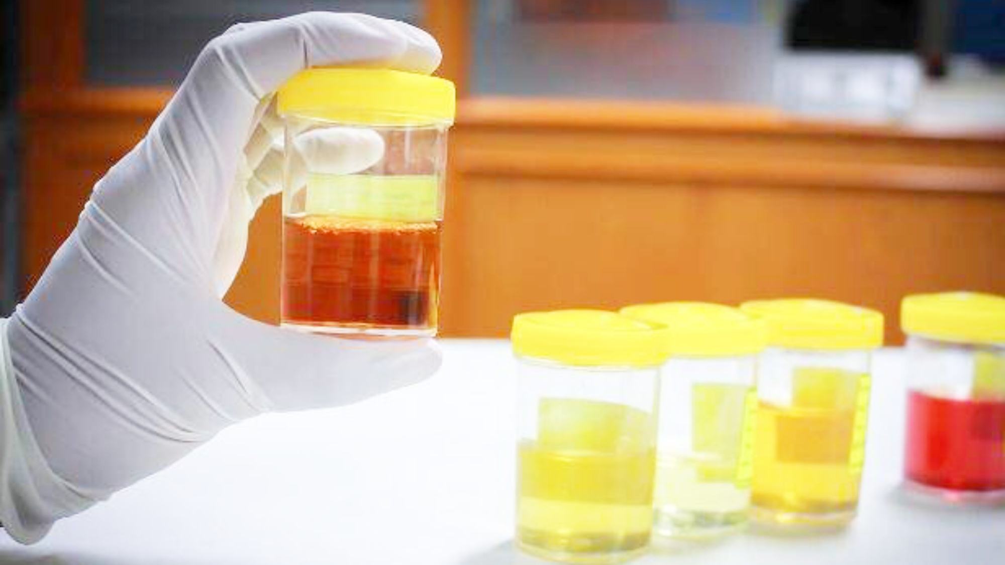 尿糖与糖尿病的区别,糖尿病人尿糖四个加号意味着什么