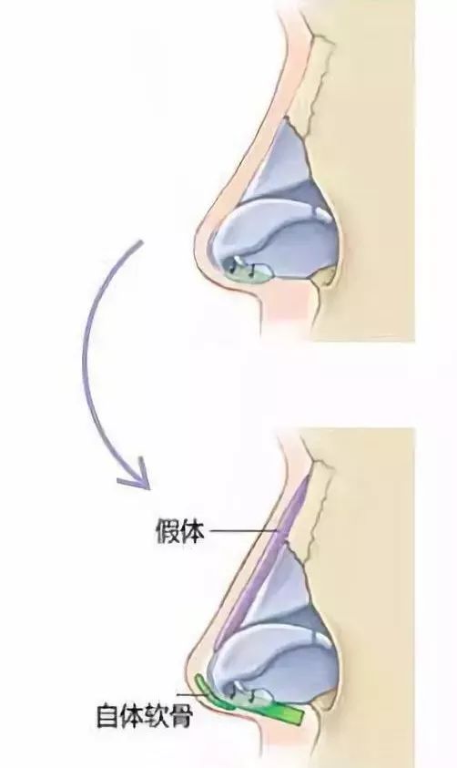 隆鼻手术十大常见问题的应对方案,隆鼻手术前应该准备带什么东西