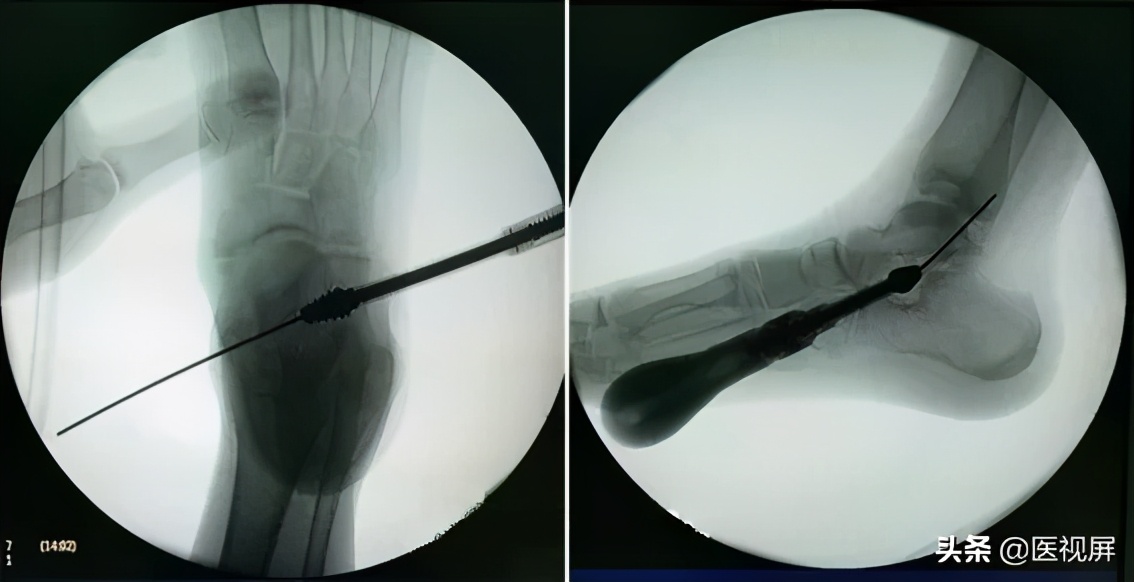 17岁平足症怎么治疗,青少年平足怎么办