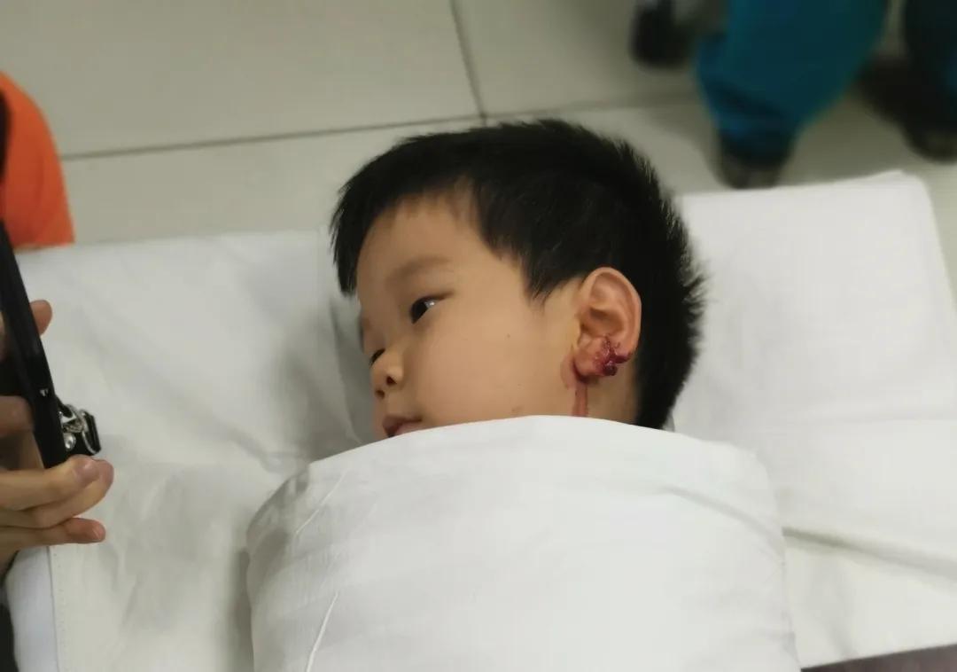 小孩耳垂根部裂开一道口子,孩子耳垂裂开了一条缝