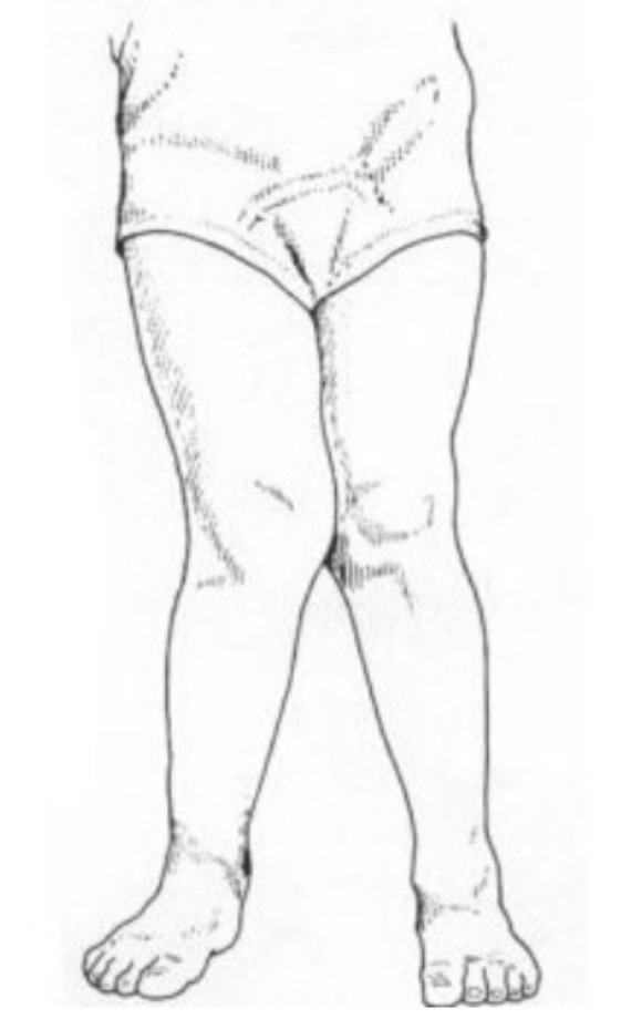 儿童肘内翻畸形,遗传右膝外翻畸形