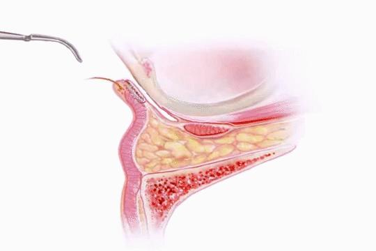 40多岁眼袋很重，还有泪沟该怎么办？听听医生怎么说...