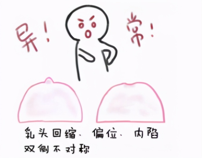 捂脸！乳头像火山口般凹陷，会影响哺乳功能吗