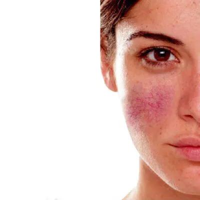 擦护肤品后疼怎么办,用完维a酸乳膏后擦护肤品刺痛