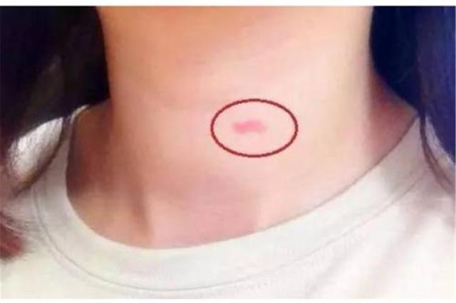 12岁女孩脖子印有“草莓”，家人痛心逼问，孩子的回答令人深思