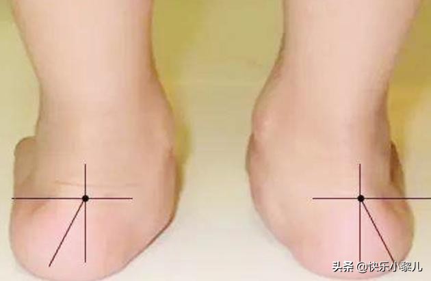 4岁宝宝的脚趾头有弯曲变形,4岁宝宝脚变形图片