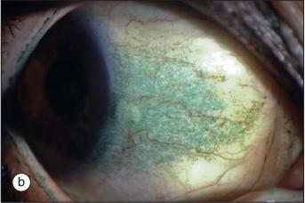 干燥综合症最怕的三种食物,干燥综合症的8大临床特征