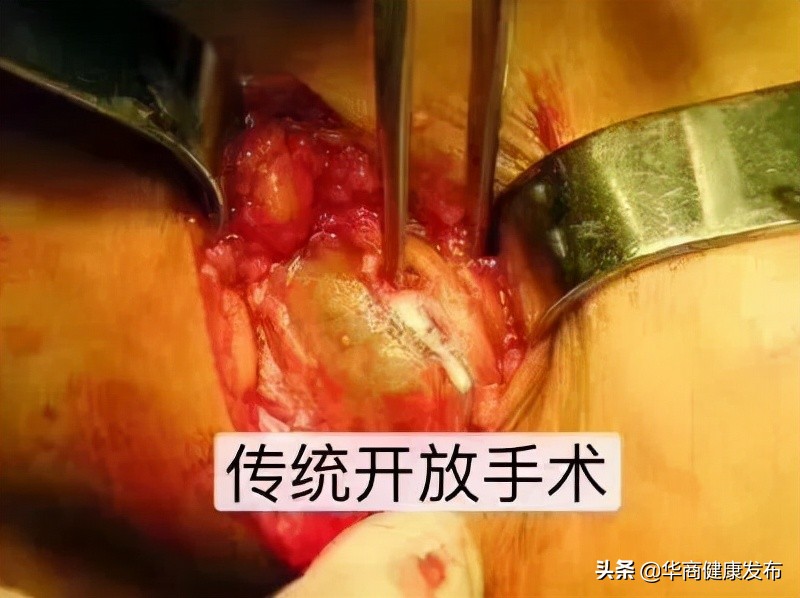 膝盖腘窝囊肿多大要手术,腘窝手术切口