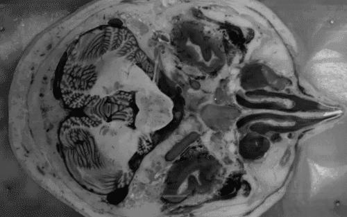 干细胞治疗帕金森病最新消息,2022年世界帕金森日主题视频