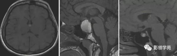 头部t1wi信号不均匀增高,脑t1wi和t2wi稍低信号