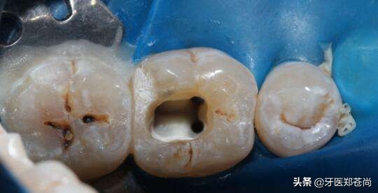 做了根管治疗的牙能矫正吗,根管治疗的牙还能用三十年吗