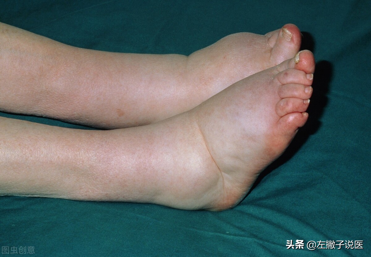 下肢水肿是心脏问题还是肾的问题,下肢水肿是湿气重吗